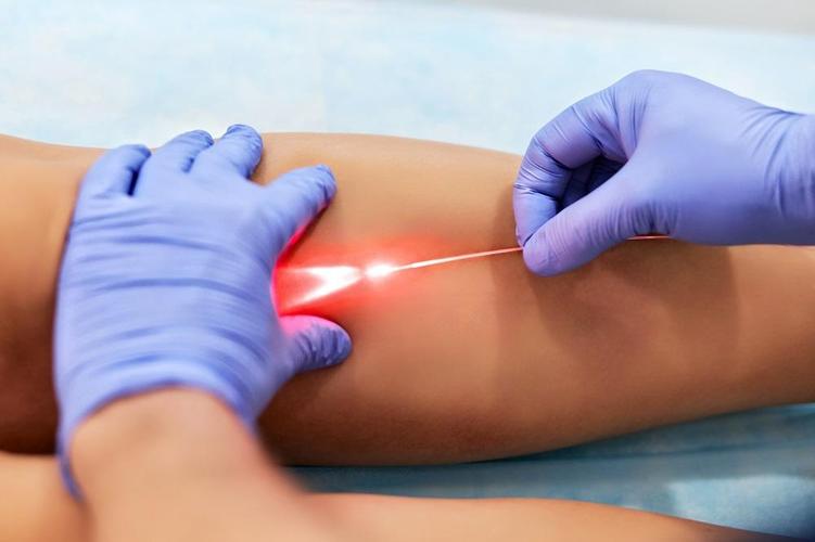 Laser treatment best sale